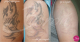Laserowe usuwanie tatuazu