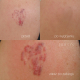 Laserowe usuwanie tatuazu